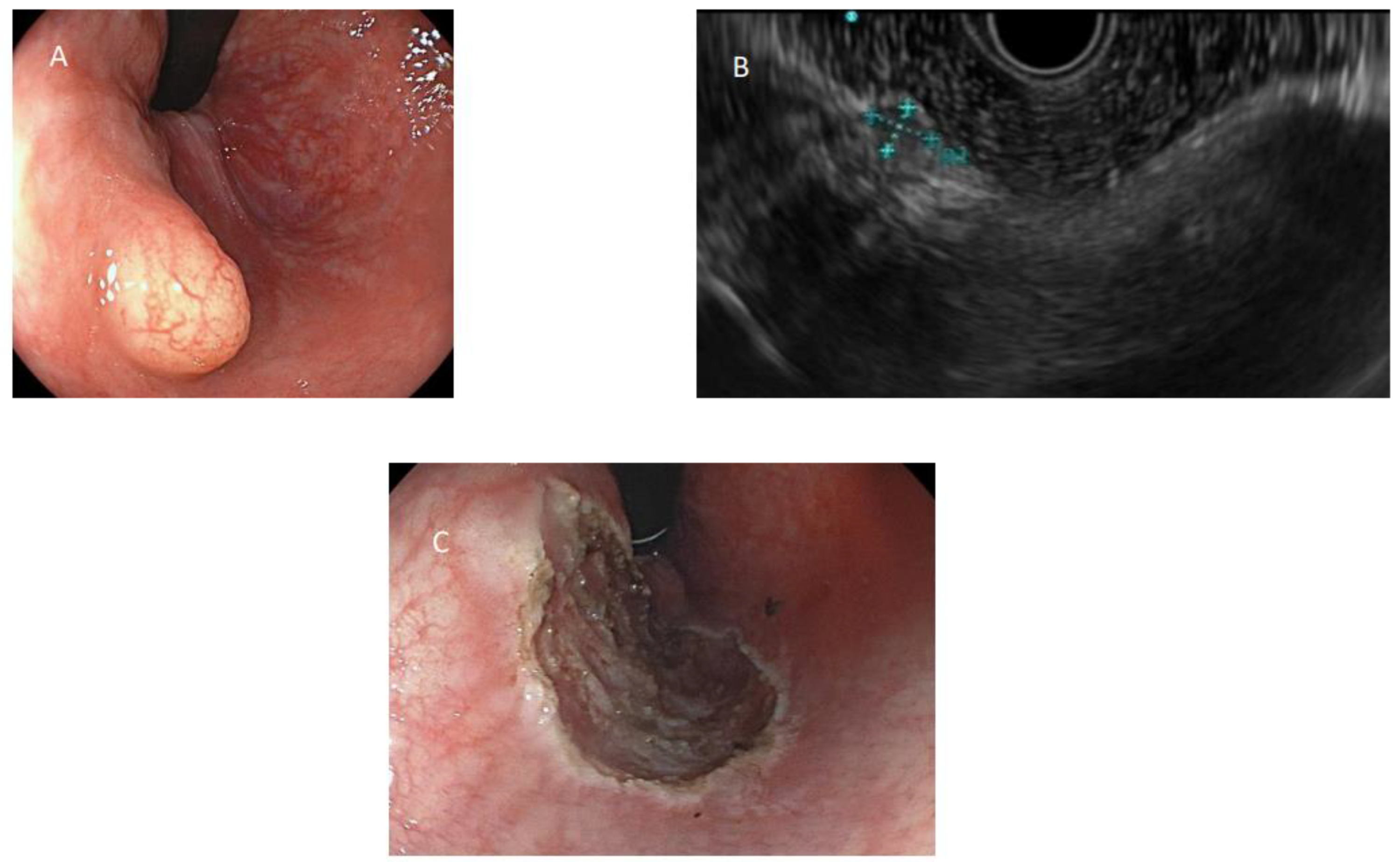 Diagnostics | Free Full-Text | Outcome of Endoscopic Resection of Rectal  Neuroendocrine Tumors ≤ 10 mm