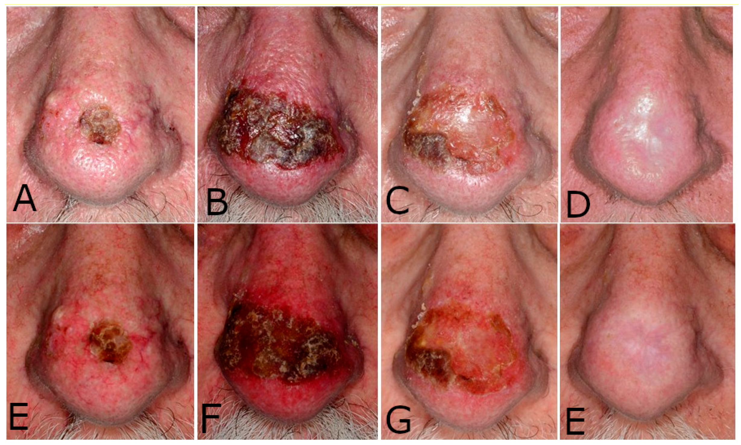 oral basal cell carcinoma