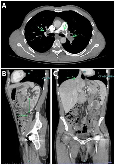 Diseases | Free Full-Text | Renal Cell Carcinoma Presenting as Syncope due  to Saddle Pulmonary Tumor Embolism