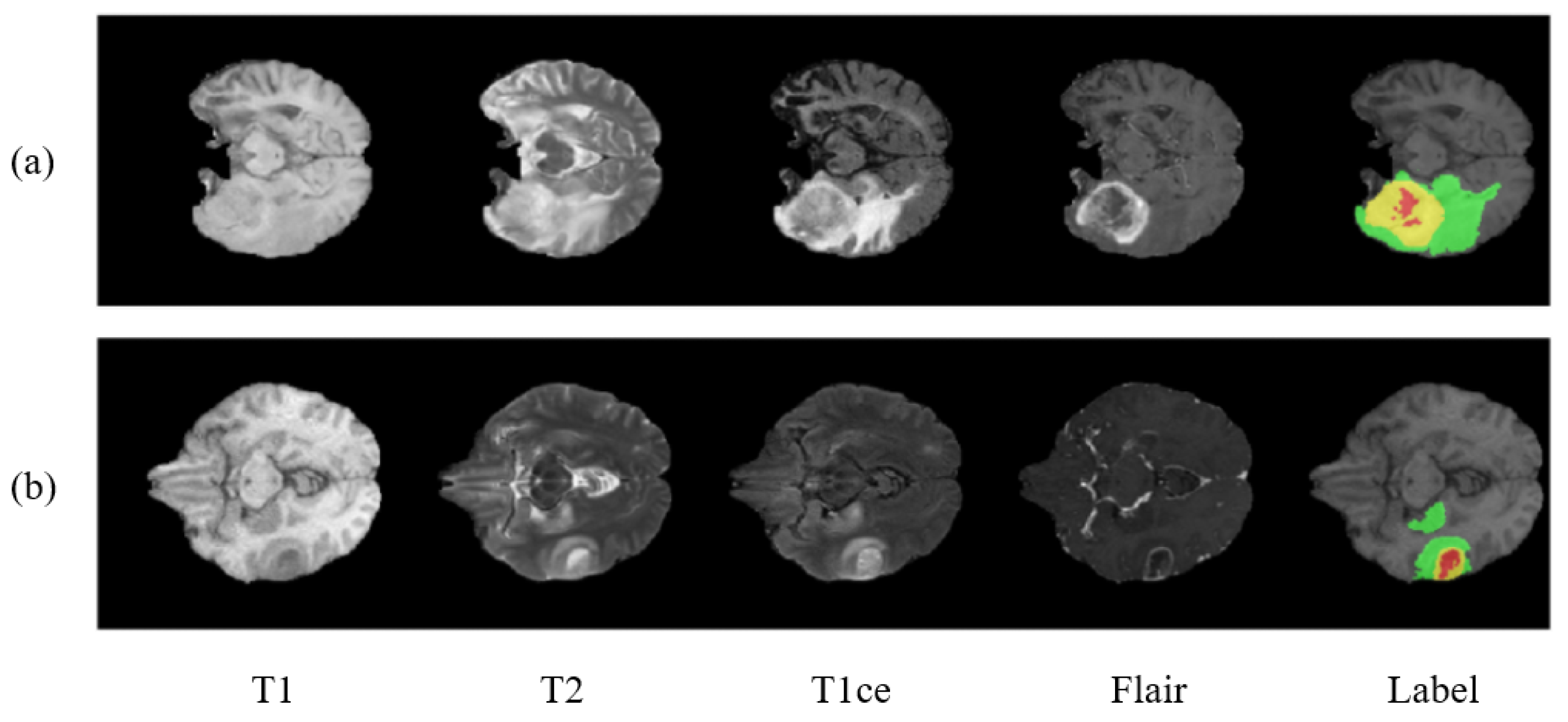 PDF] Brain Tumor Segmentation of MRI Images Using Processed Image Driven  U-Net Architecture