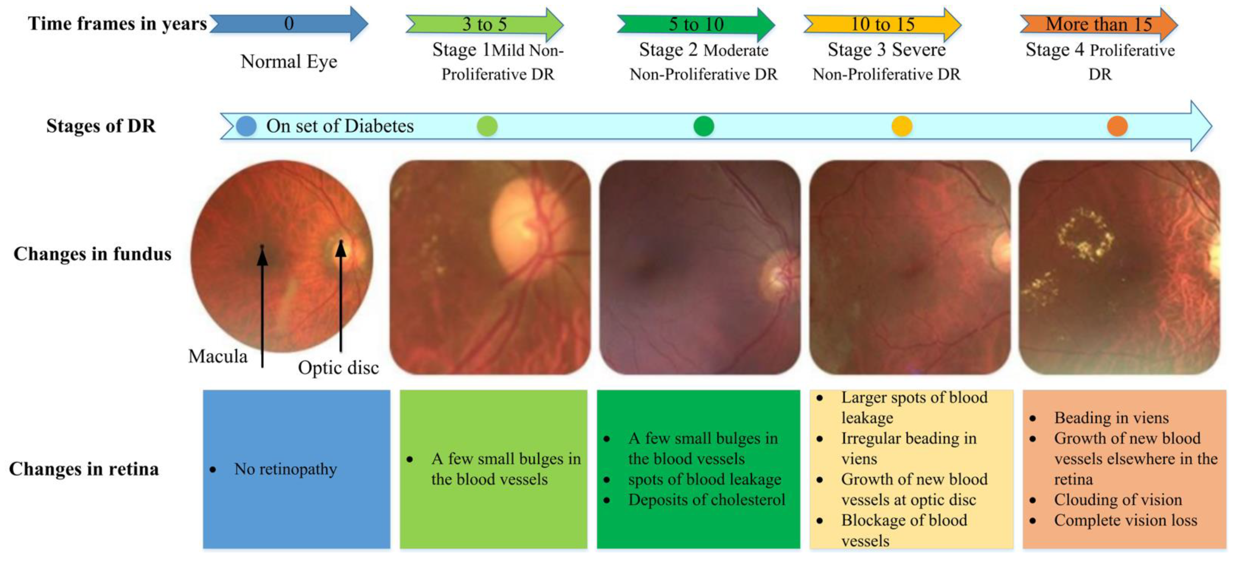 Electronics | Free Full-Text | Detection of Diabetic Retinopathy in Retinal  Fundus Images Using CNN Classification Models