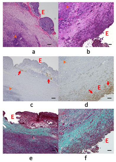 Endocrines | Free Full-Text | The Effects of Endometriosis on