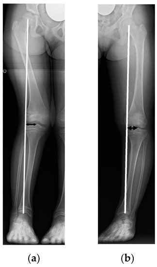 File:Orthopedic leg braces - adolescent female patient 3.jpg - Wikimedia  Commons