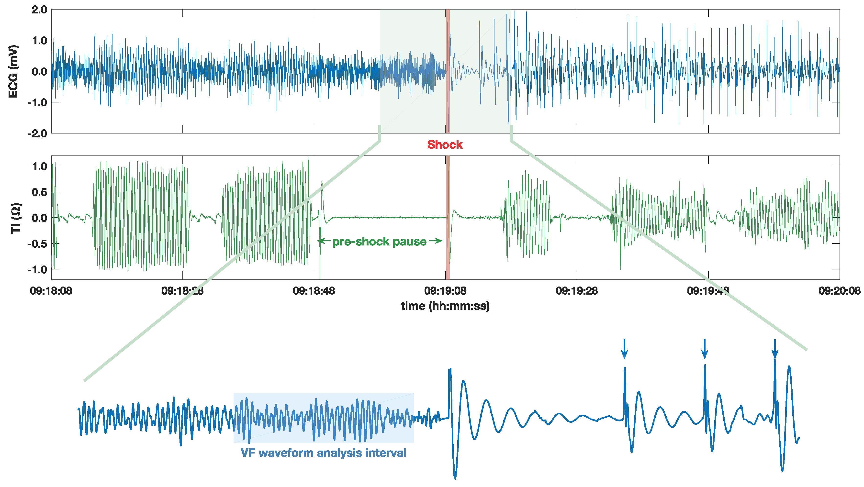 Entropy | Free Full-Text | Fuzzy and Sample Entropies as Predictors of  Patient Survival Using Short Ventricular Fibrillation Recordings during out  of Hospital Cardiac Arrest