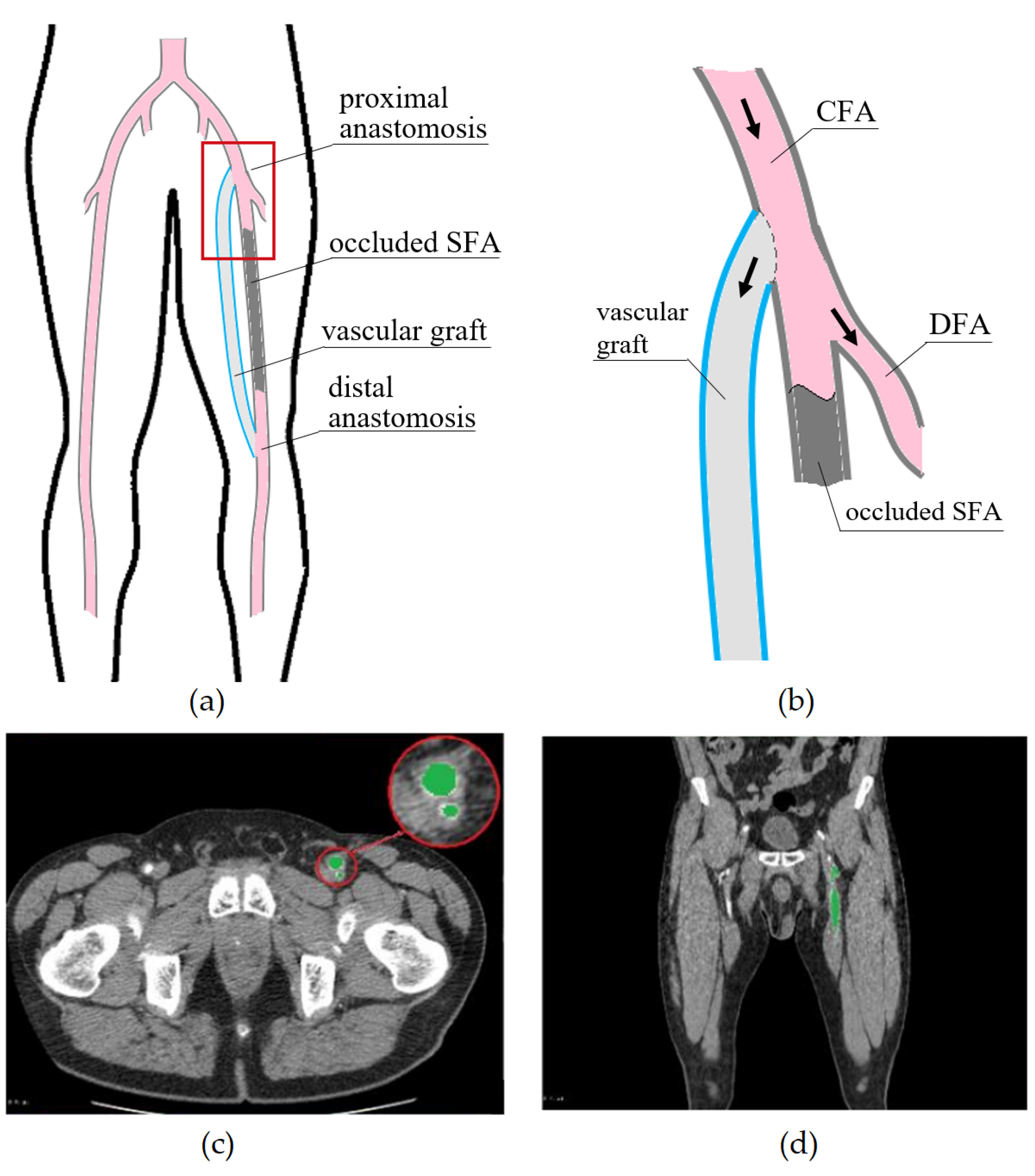 Fluids | Free Full-Text | Experience of Patient-Specific CFD Simulation of  Blood Flow in Proximal Anastomosis for Femoral-Popliteal Bypass