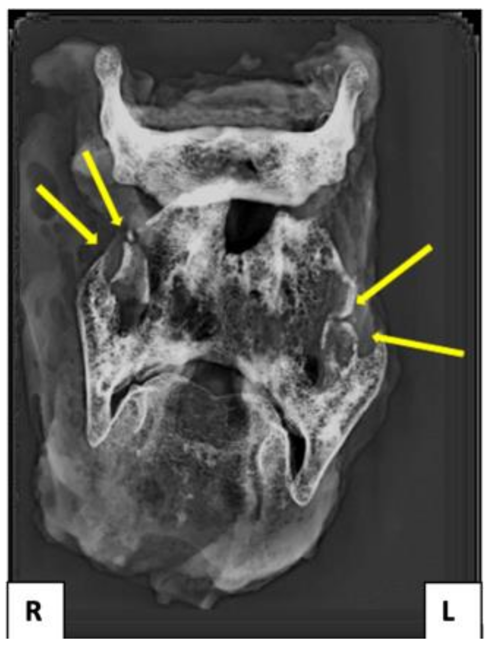 thyroid cartilage x ray