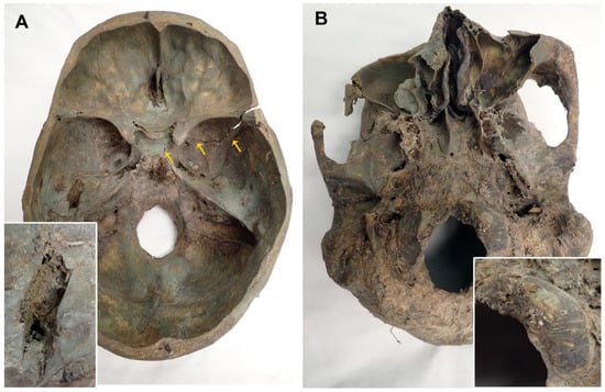 Forensic Artist Reconstructs Face From A Skull-Shaped Vodka Bottle