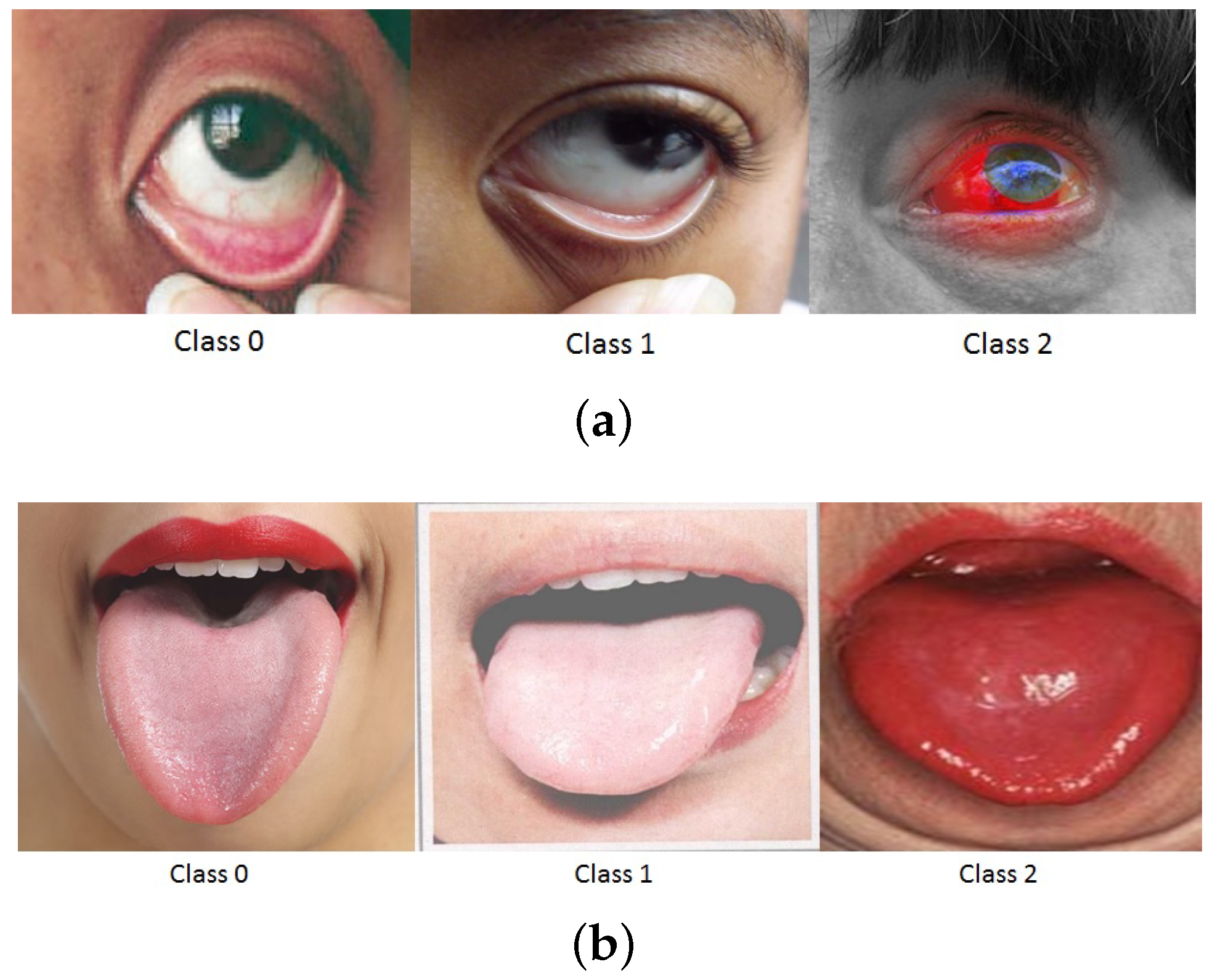 anemia symptoms eye