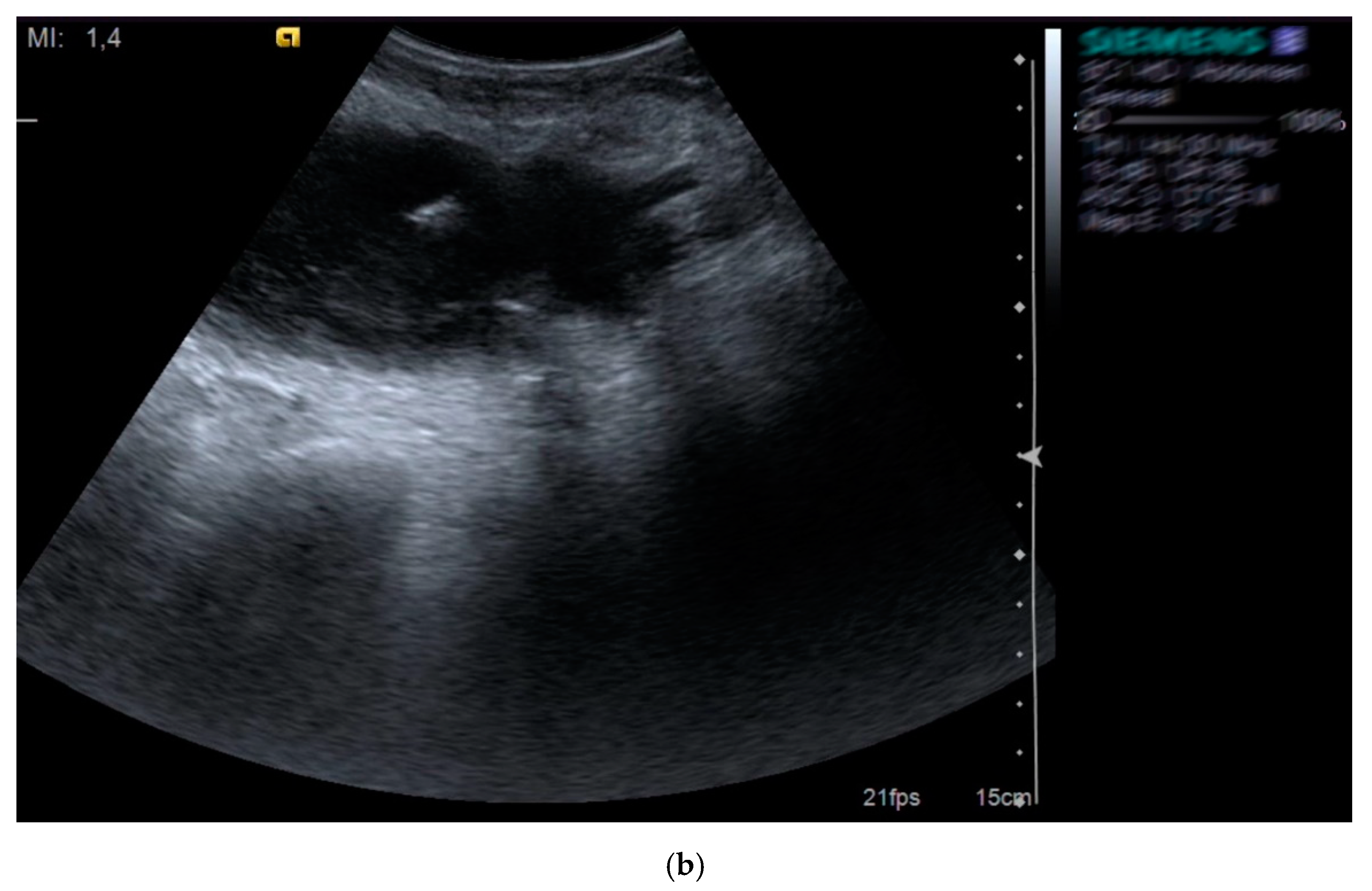 Gastroenterology Insights | Free Full-Text | Ultrasound-Guided Percutaneous  Drainage of Abdominal Collections—An Analysis over 5 Years | HTML