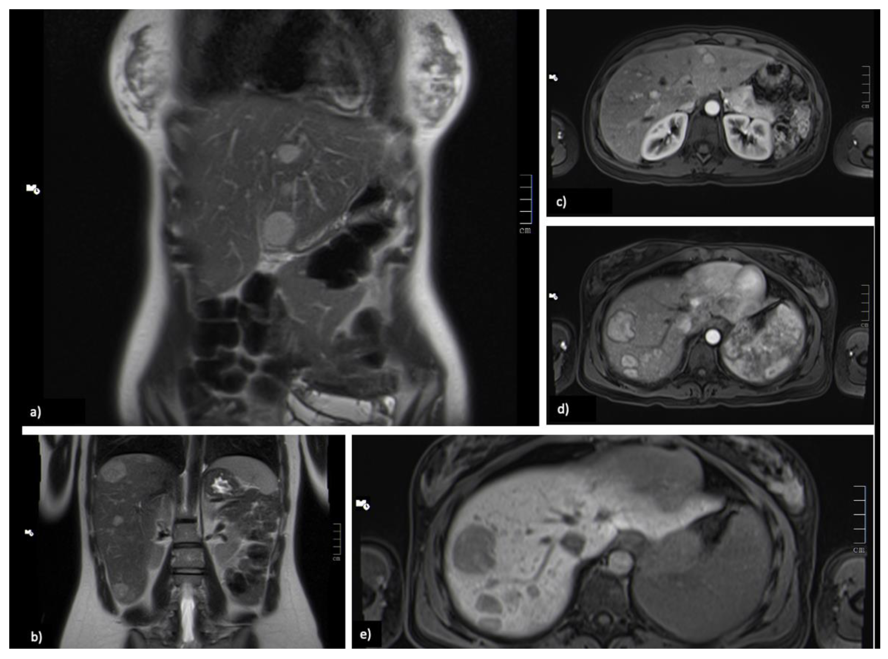 PDF) Uncommon liver tumors: Case report and literature review