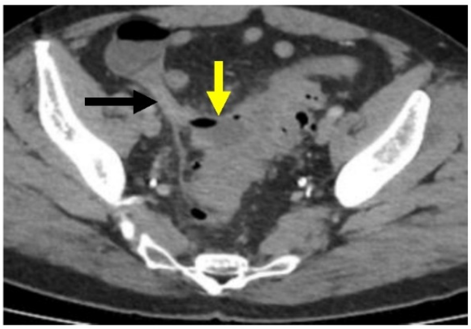 Gastroent 13 00033 g005 Gastroent 13 00033 g005