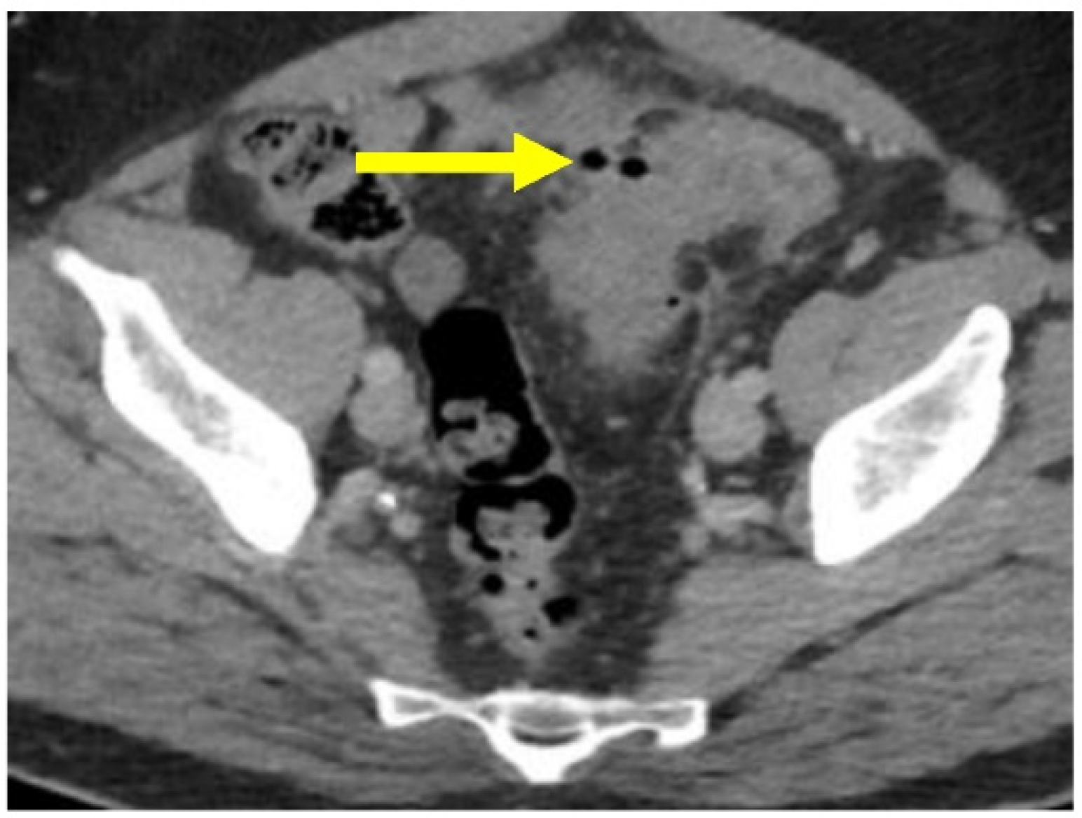 Gastroent 13 00033 g006 Gastroent 13 00033 g006