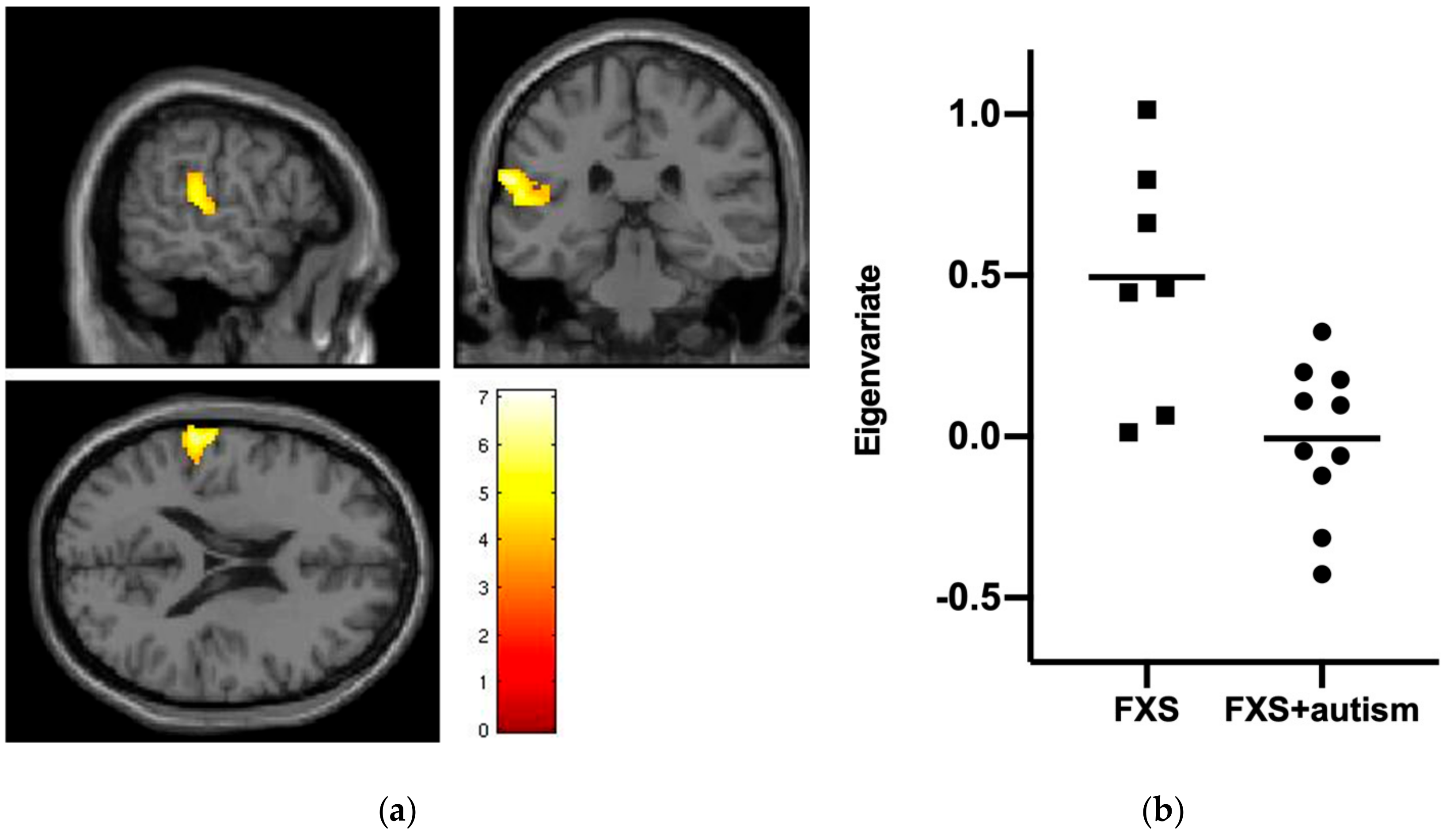 Genes Free Full Text Autism In Fragile X Syndrome A Functional Mri Study Of Facial Emotion Processing Html