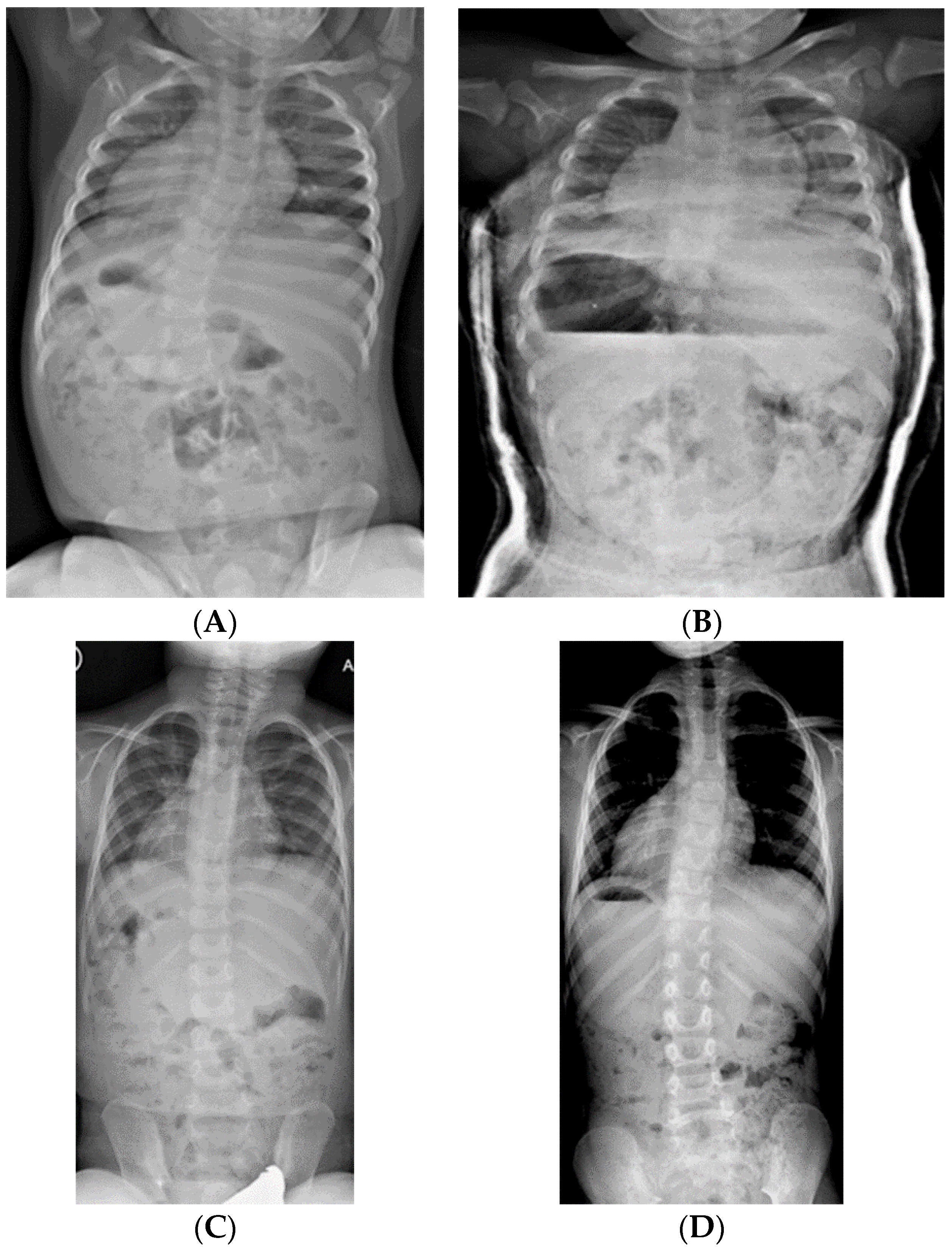 Genes | Free Full-Text | Clinical Observations and Treatment Approaches for  Scoliosis in Prader–Willi Syndrome