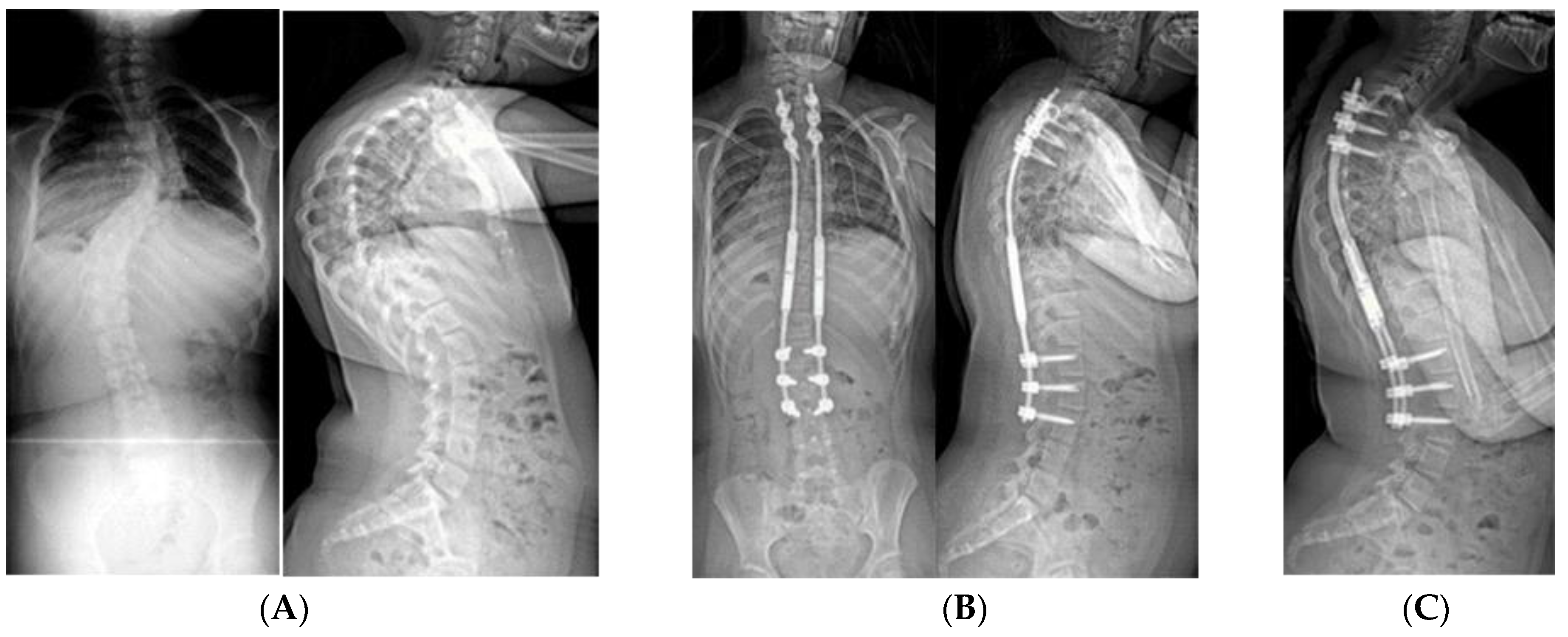 Genes | Free Full-Text | Clinical Observations and Treatment Approaches for  Scoliosis in Prader–Willi Syndrome