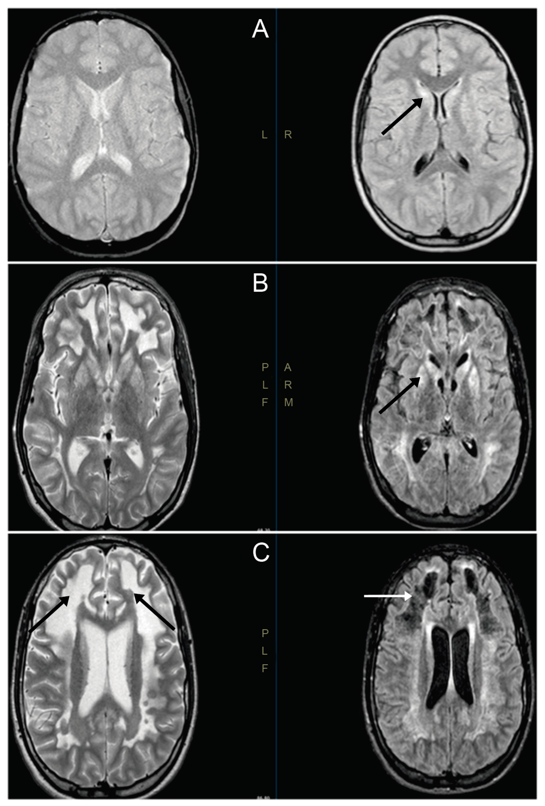 Genes | Free Full-Text | Leigh Syndrome in a Pedigree Harboring 