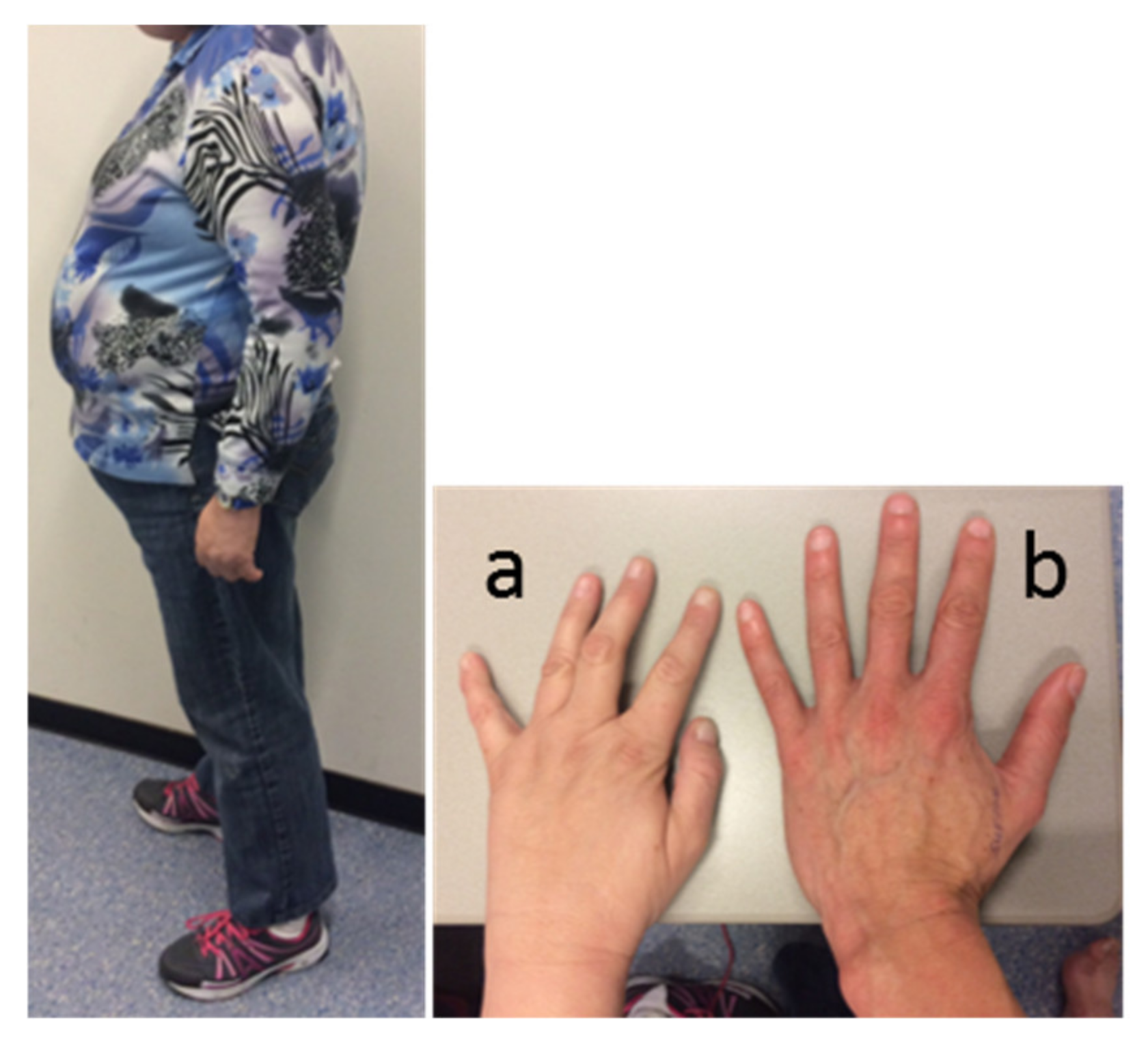 Small hands characteristic of Prader-Willi syndrome.