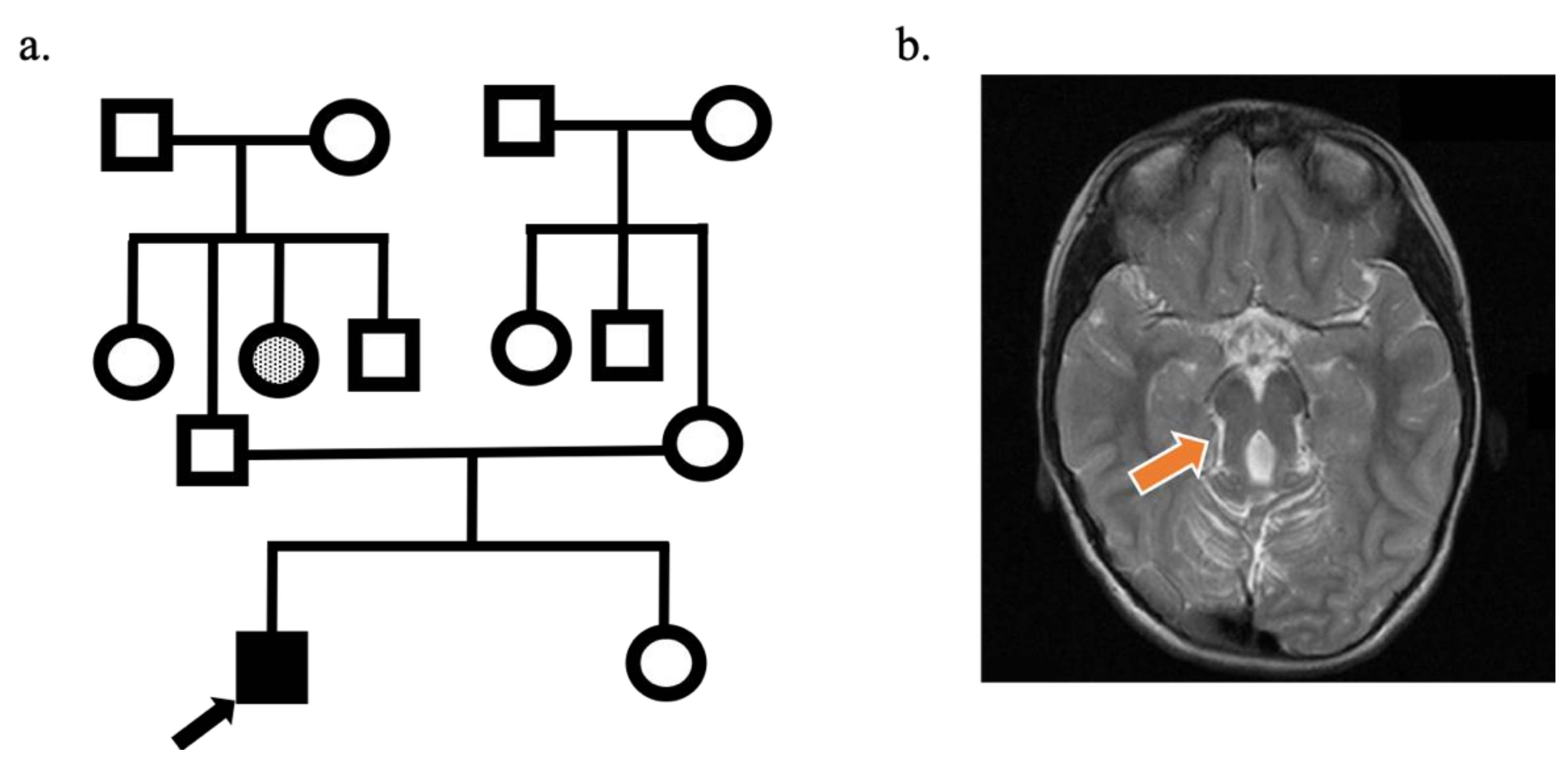 Genes | Free Full-Text | A Homozygous Synonymous Variant Likely Cause of  Severe Ciliopathy Phenotype