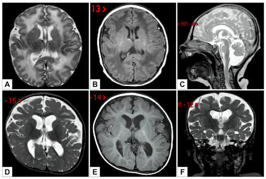 Genes | Free Full-Text | Adducted Thumb and Peripheral Polyneuropathy ...