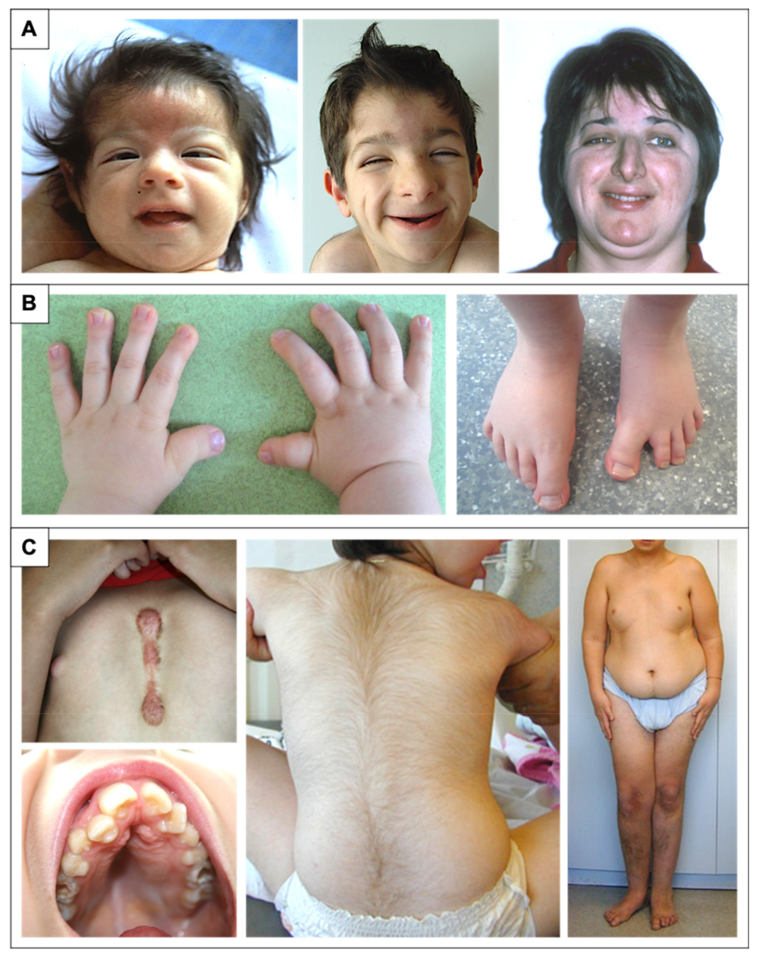 Rubinstein-Taybi syndrome: clinical features, genetic basis