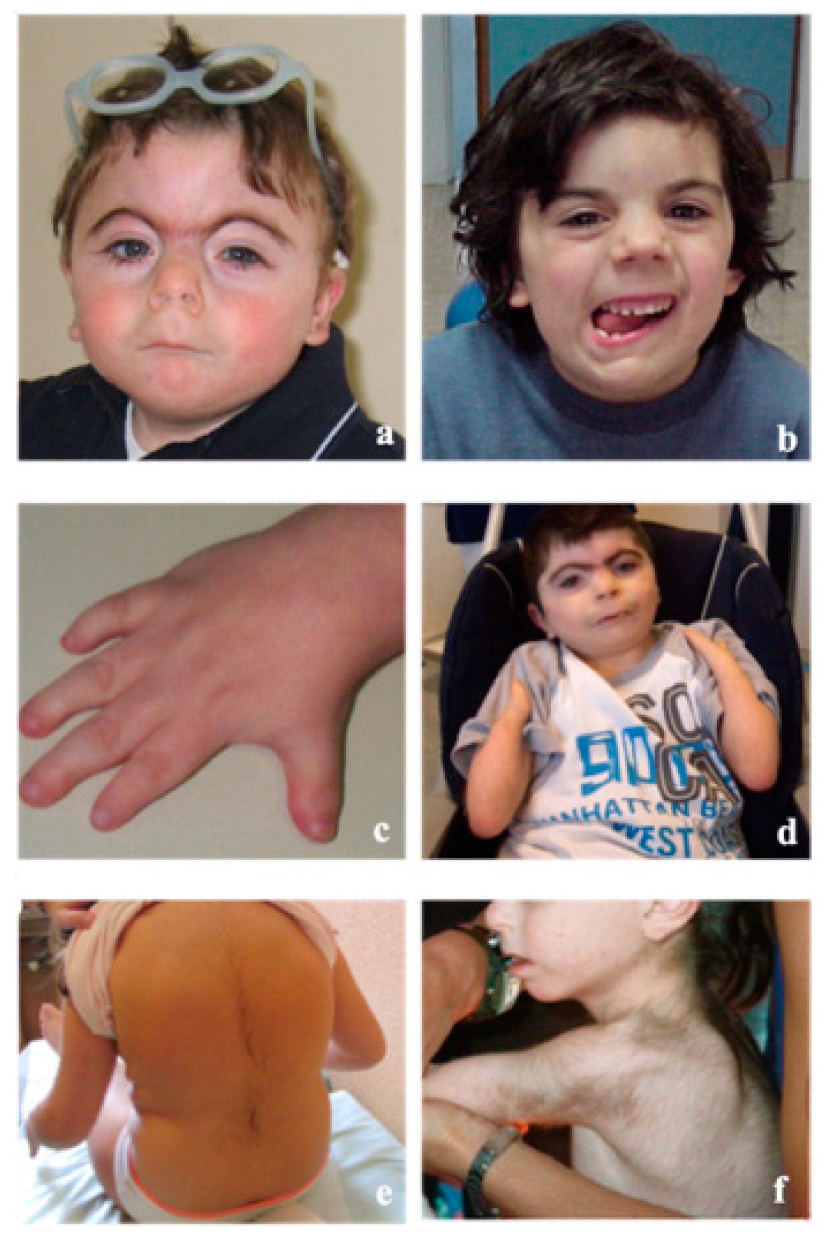 Genes | Free Full-Text | Cornelia de Lange Syndrome: From a Disease to a  Broader Spectrum | HTML