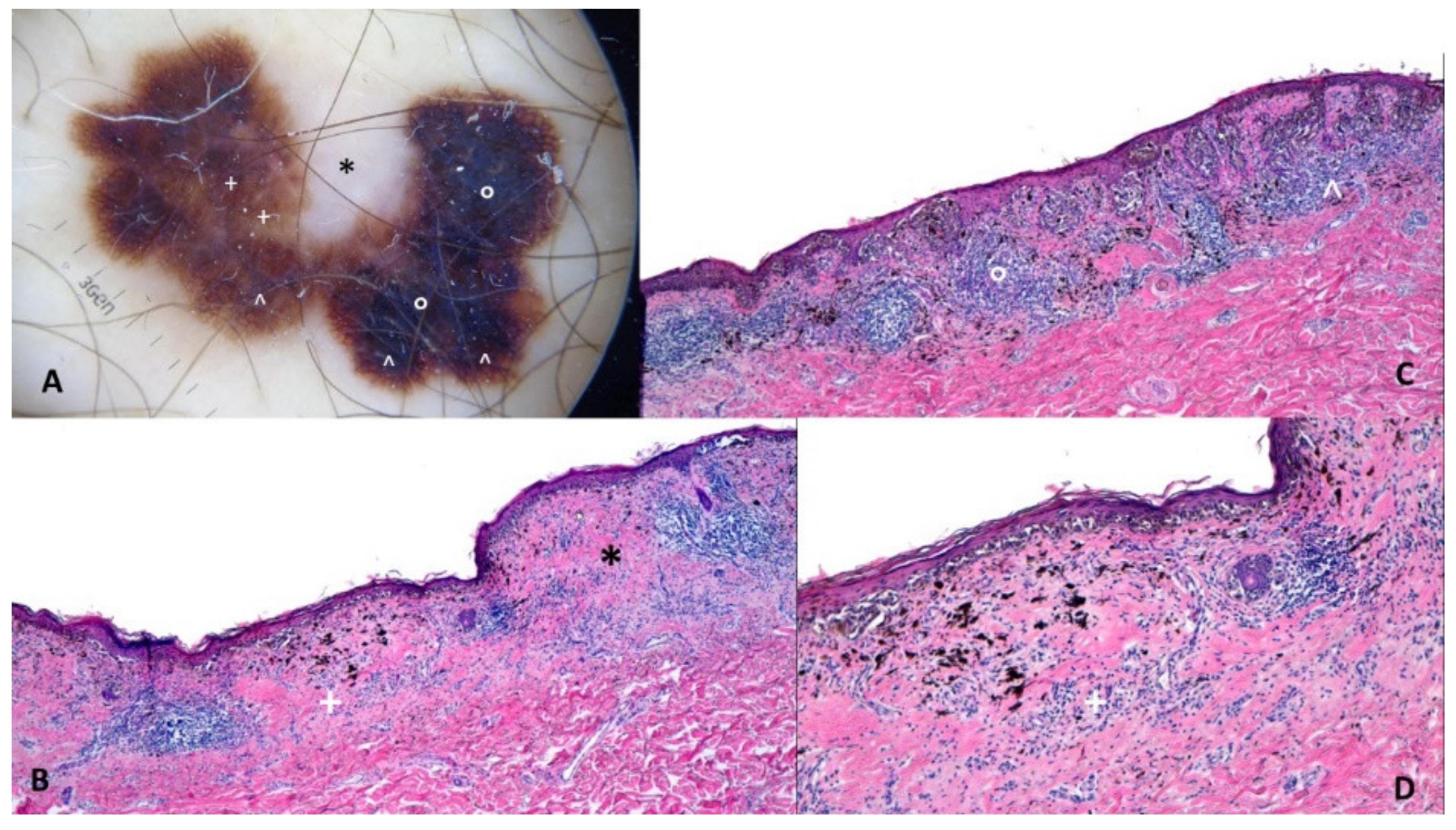 acral lentiginous melanoma histology