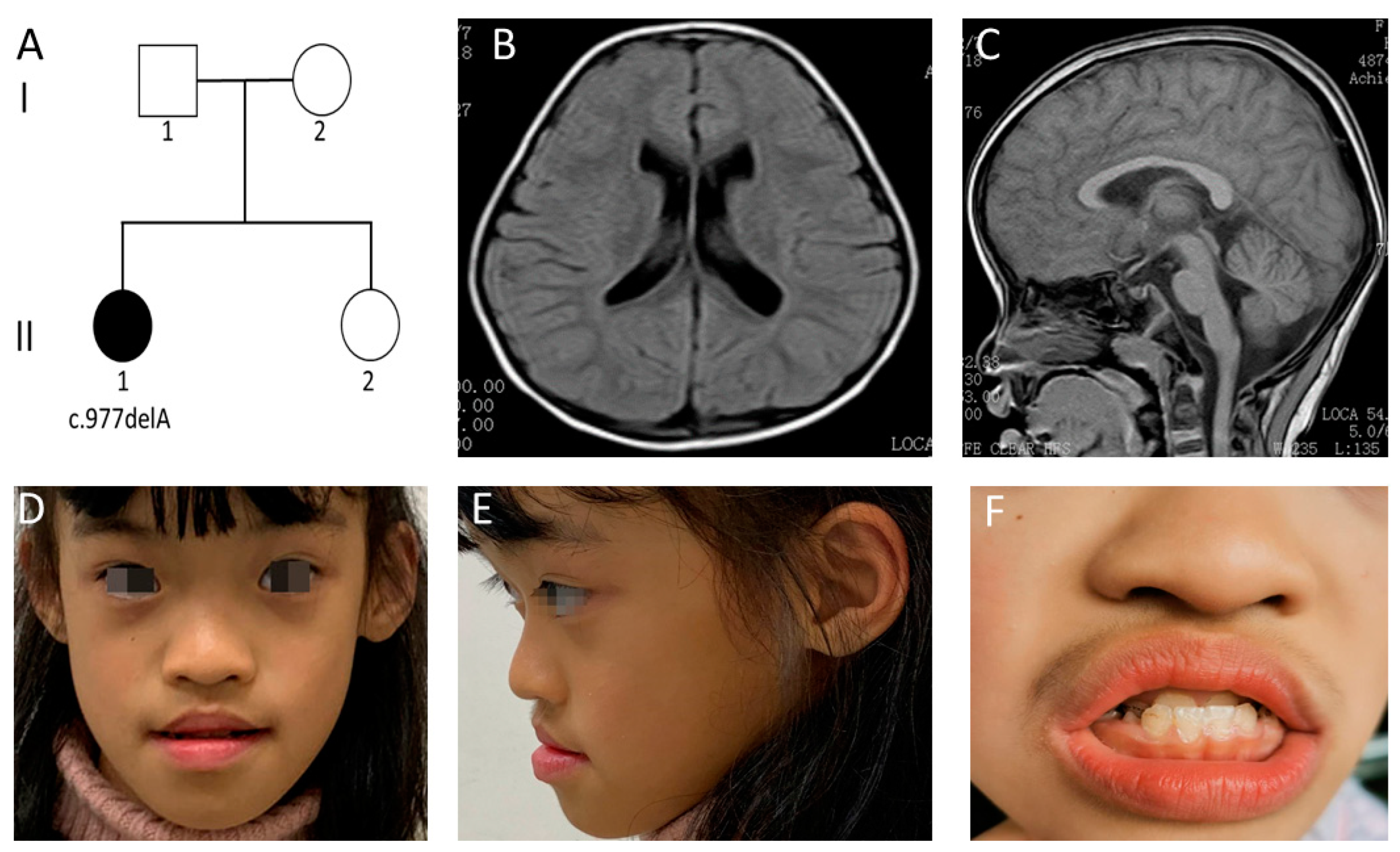 Clinical and mutational spectrum in Korean patients with Rubinstein–Taybi  syndrome: The spectrum of brain MRI abnormalities - ScienceDirect