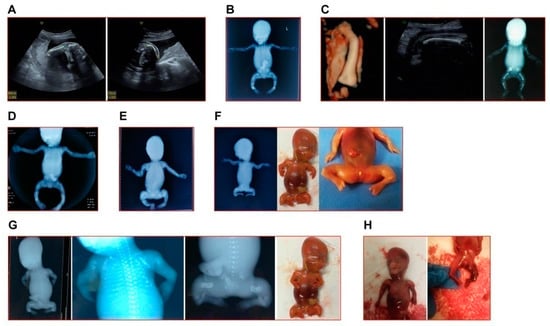 Genes | Free Full-Text | Prenatal Cases Reflect The Complexity Of The ...