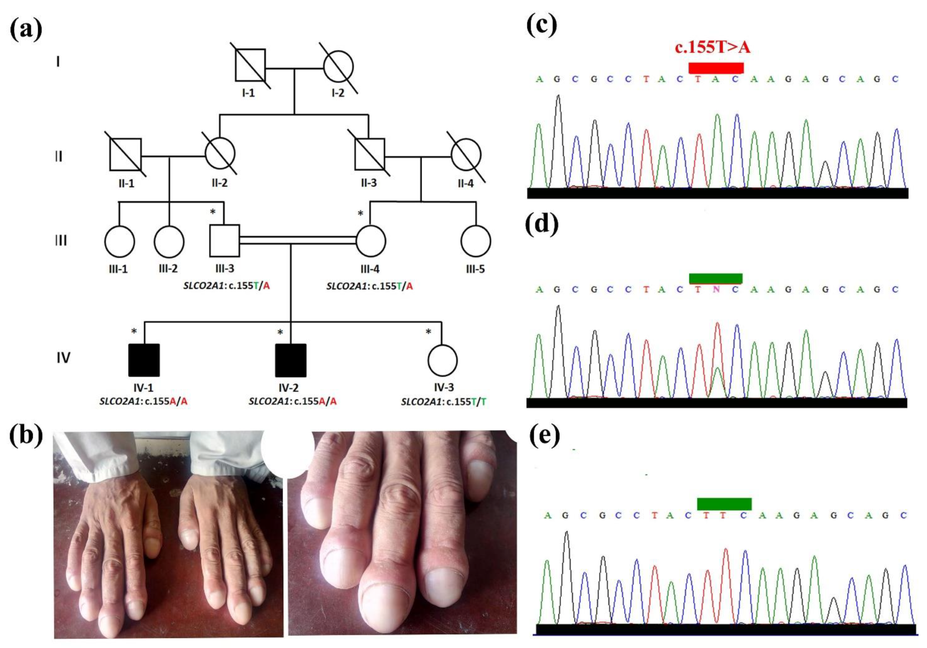 Genes | Free Full-Text | Homozygous Missense Variant in the Solute Carrier  Organic Anion Transporter 2A1 (SLCO2A1) Gene Underlies Isolated Nail  Clubbing