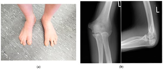 Fourth-Generation Minimally Invasive Hallux Valgus Surgery With Metaphyseal  Extra-Articular Transverse and Akin Osteotomy (META): 12 Month Clinical and  Radiologic Results - Thomas L. Lewis, Benjamin Lau, Yousif Alkhalfan,  Samuel Trowbridge, David Gordon,