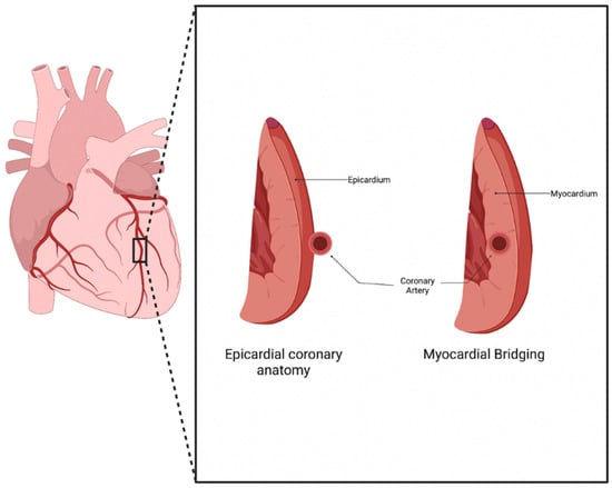 Update on Myocardial Bridging