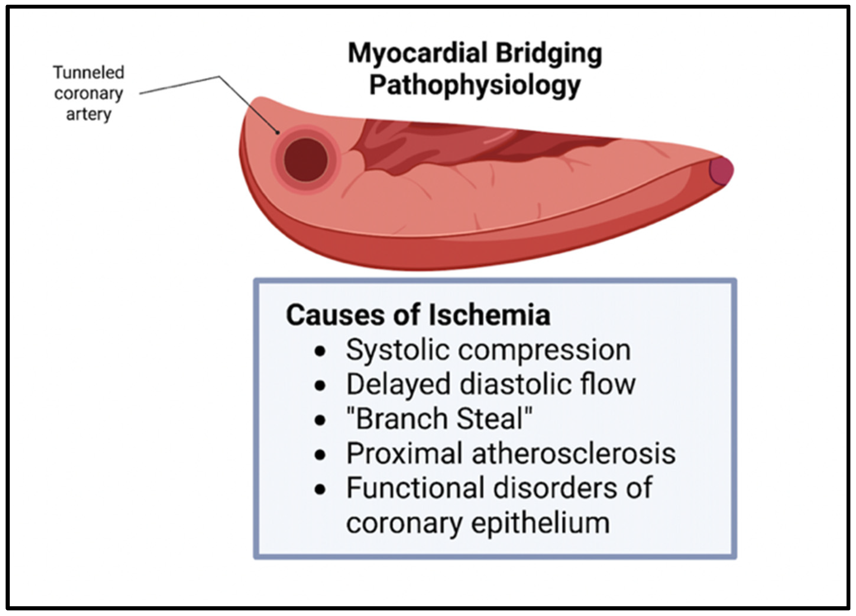 Update on Myocardial Bridging