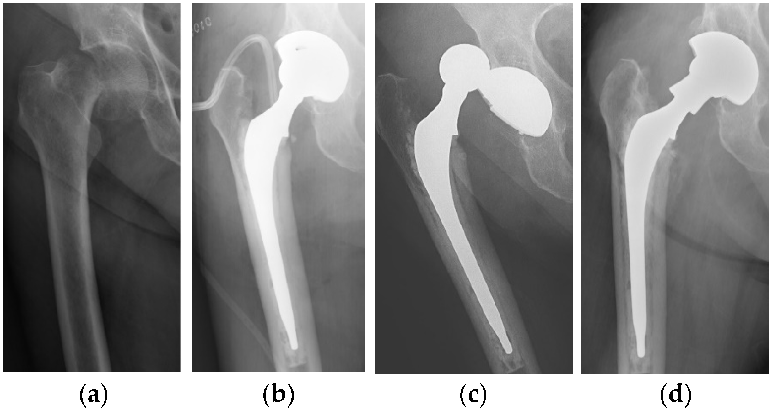 total hip vs hemiarthroplasty femoral neck fracture