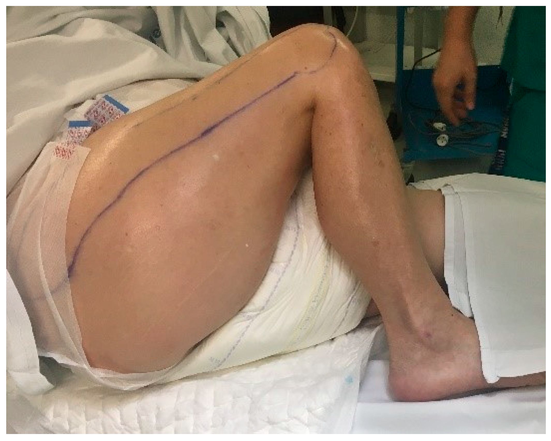 two-year postoperative view of the patient (wearing underwear) showing