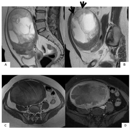 Healthcare Free Full Text Differential Diagnosis Of Uterine Leiomyoma And Uterine Sarcoma