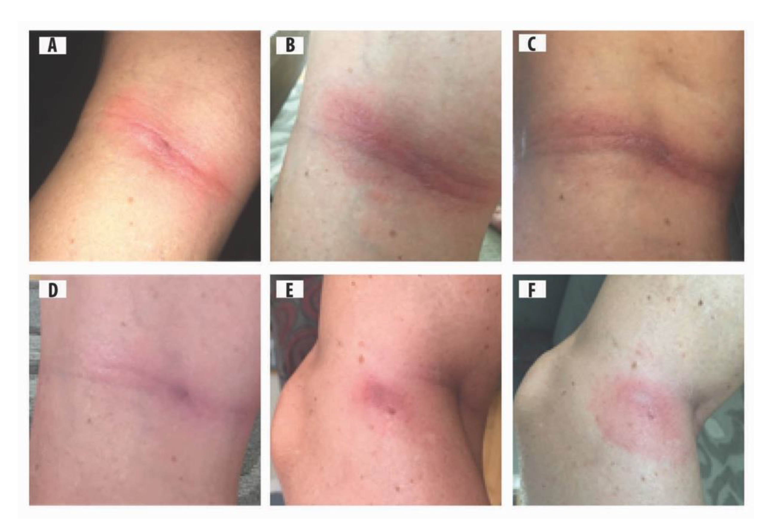 Healthcare | Free Full-Text | Presentation of Acrodermatitis Chronica  Atrophicans Rashes on Lyme Disease Patients in Canada