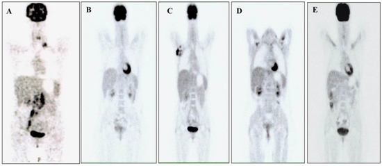 Healthcare | Free Full-Text | How Fear of COVID-19 Can Affect Treatment  Choices for Anaplastic Large Cell Lymphomas ALK+ Therapy: A Case Report |  HTML