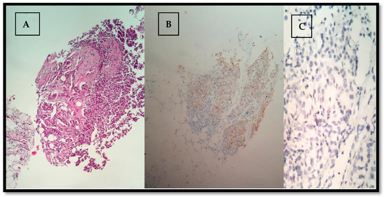 Healthcare | Free Full-Text | Correlation between Androgen Receptor  Expression and Immunohistochemistry Type as Prognostic Factors in a Cohort  of Breast Cancer Patients: Result from a Single-Center, Cross Sectional  Study