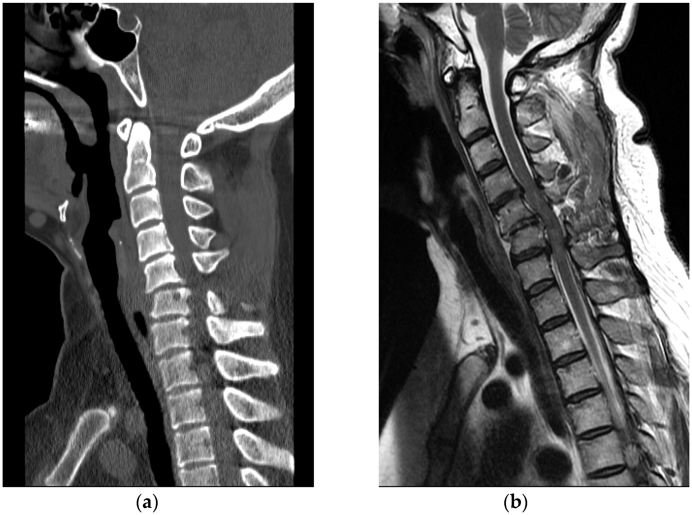 Healthcare | Free Full-Text | Inversion Table Fall Injury, the Phantom  Menace: Three Case Reports on Cervical Spinal Cord Injury