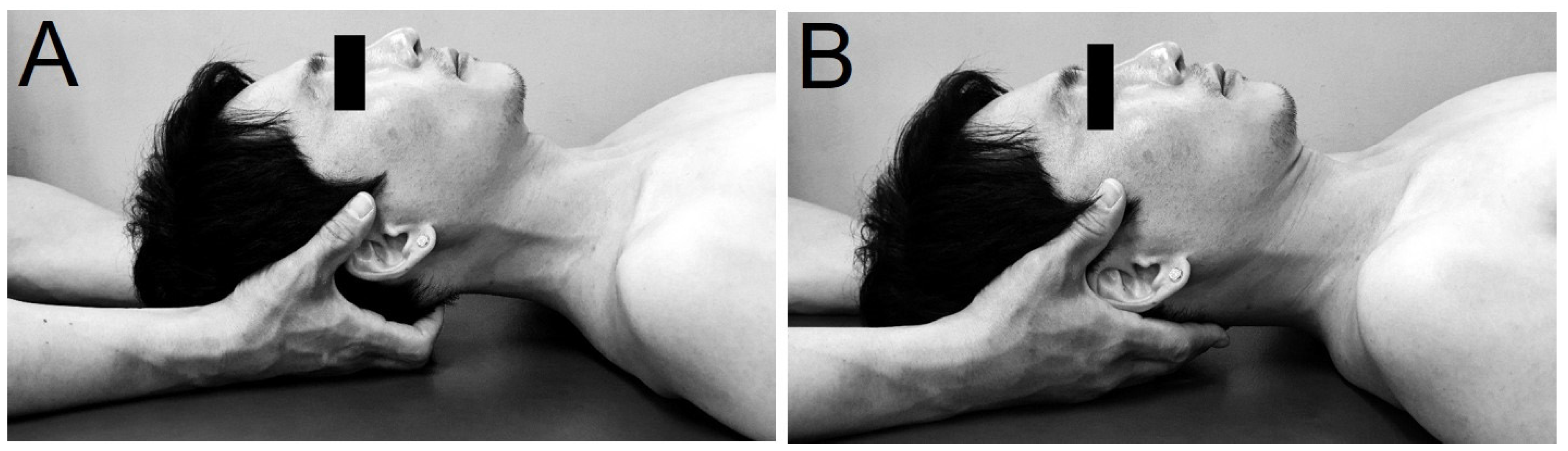 Normal dorsiflexion (left) & marked limitation of neck flexion (right).