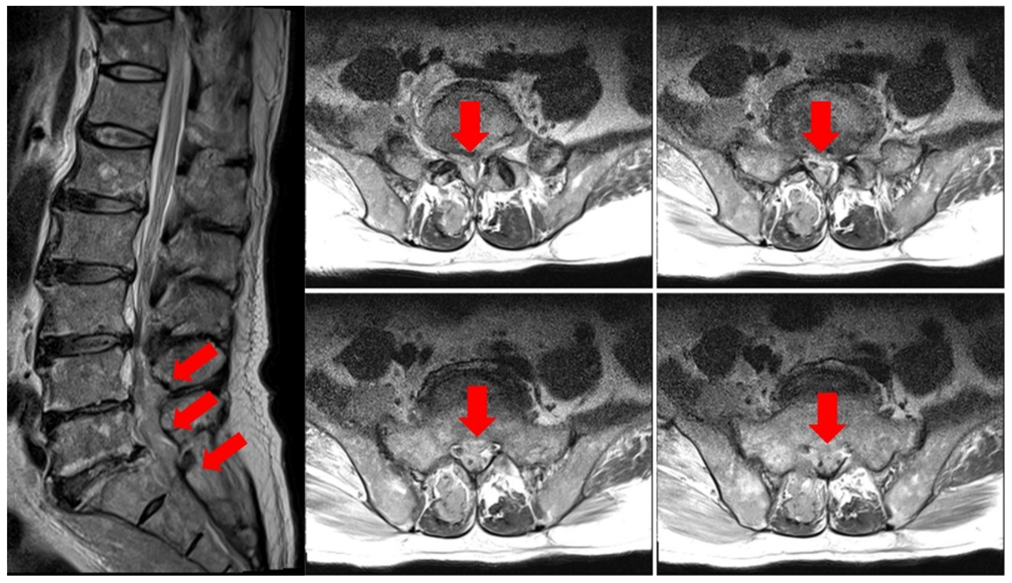 Healthcare | Free Full-Text | Unilateral Cauda Equina Syndrome Due to  Cancer Metastasis Diagnosed with Electromyography: A Case Report