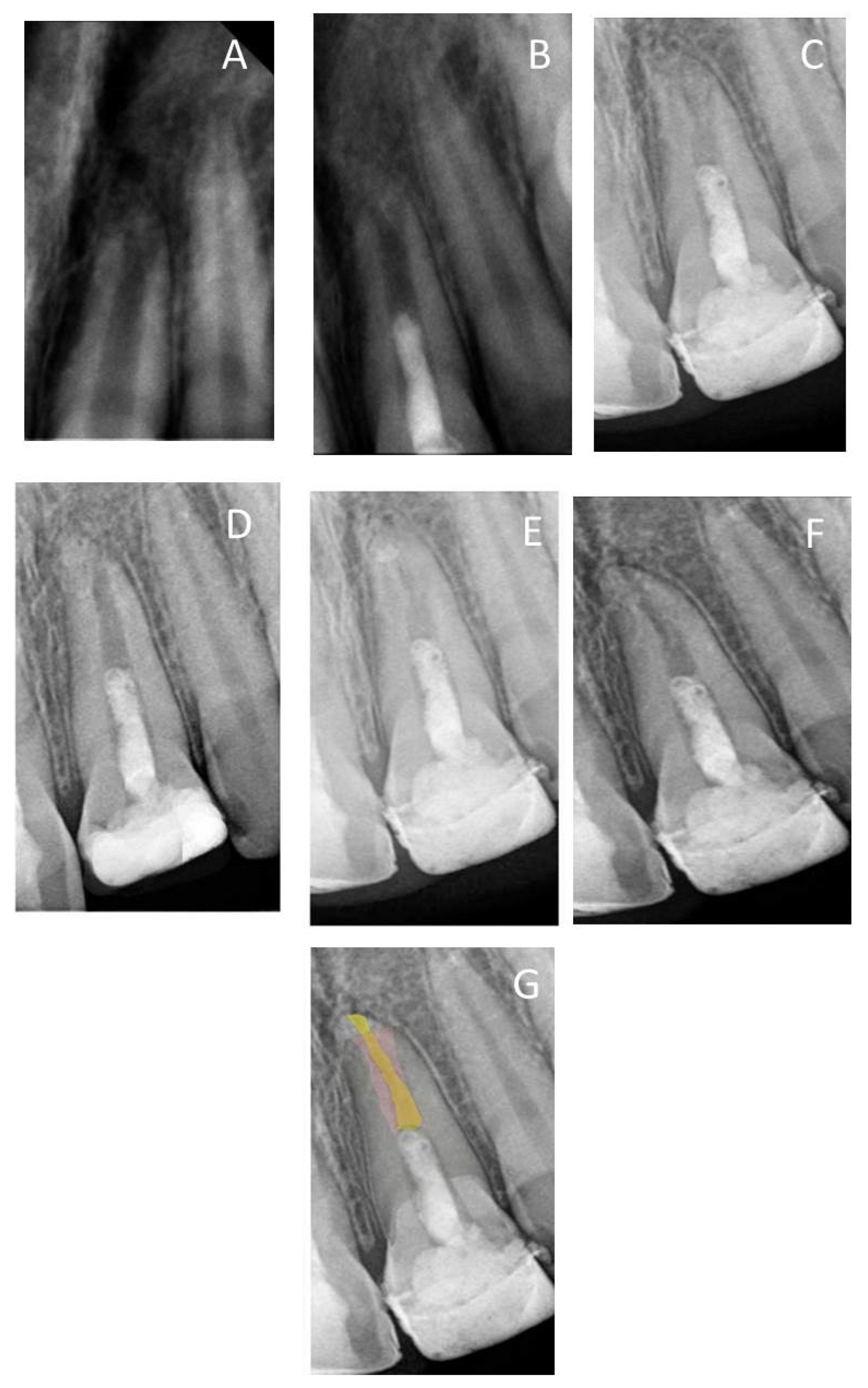 A) Preoperative periapical radiograph of tooth #21. Note the