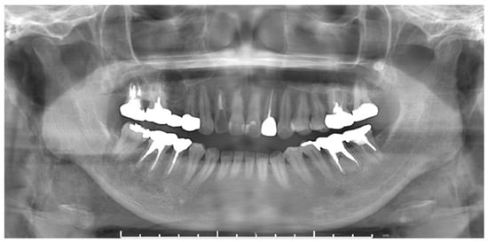 Subcutaneous Emphysema Related to Dental Treatment: A Case Series