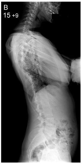 Healthcare | Free Full-Text | All Pedicle Screw versus Hybrid Hook ...