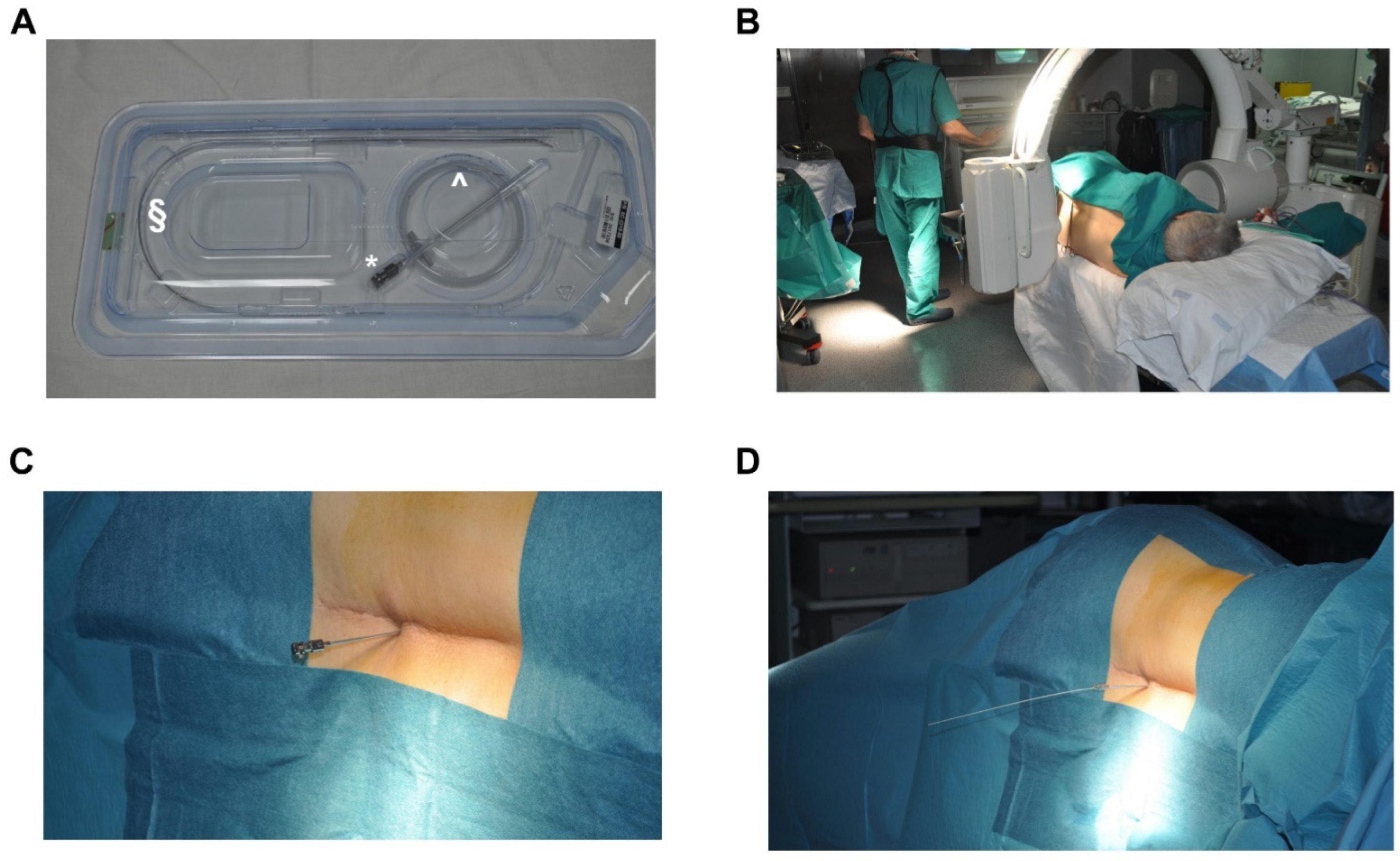 Learn How Spinal Cord Stimulators Provide Pain Relief After Failed Back  Surgery: Glaser Pain Relief Center: Interventional Pain Management  Specialists