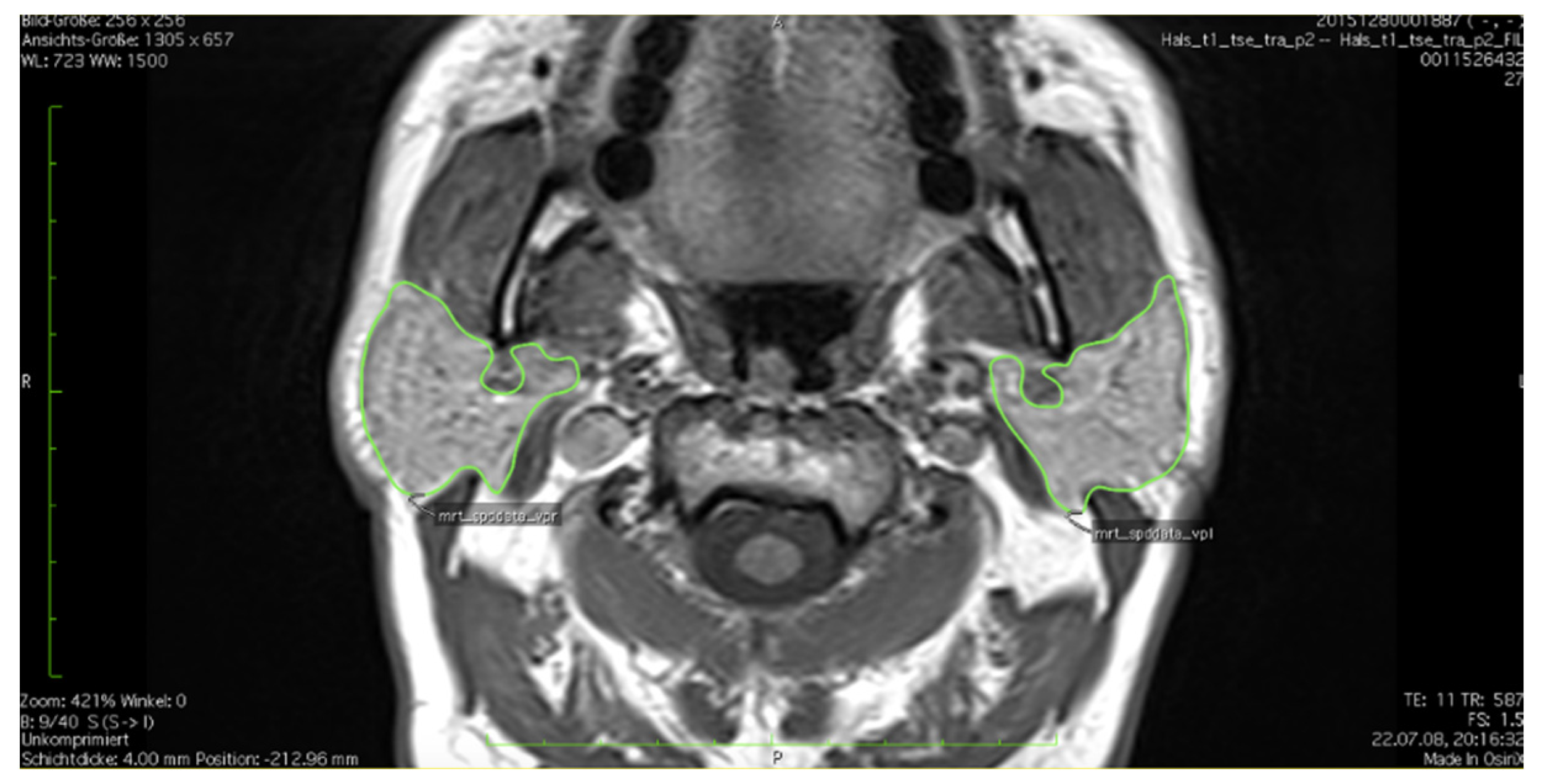 Healthcare | Free Full-Text | Population Based Average Parotid Gland Volume  and Prevalence of Incidental Tumors in T1-MRI