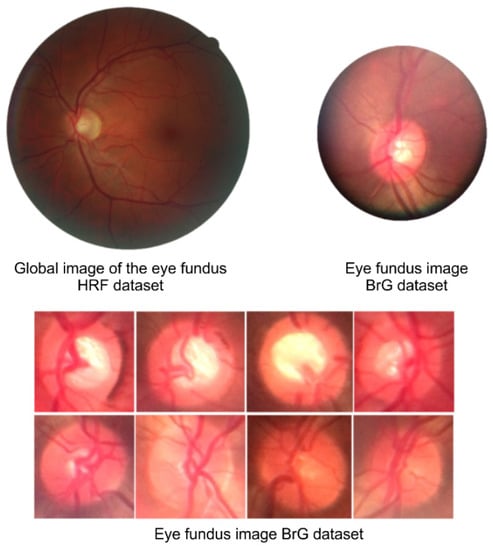 Healthcare | Free Full-Text | Detection of Glaucoma on Fundus Images ...