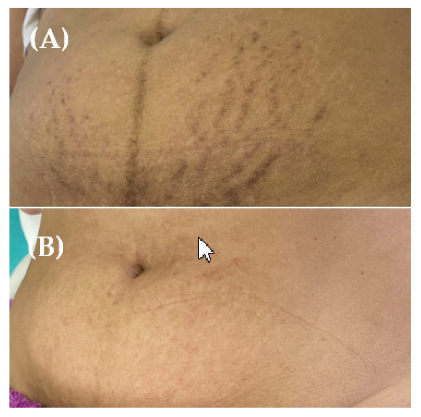 Healthcare | Free Full-Text | Fractional CO2 Laser versus Fractional  Radiofrequency for Skin Striae Treatment: Study Protocol for a Randomized  Controlled Trial