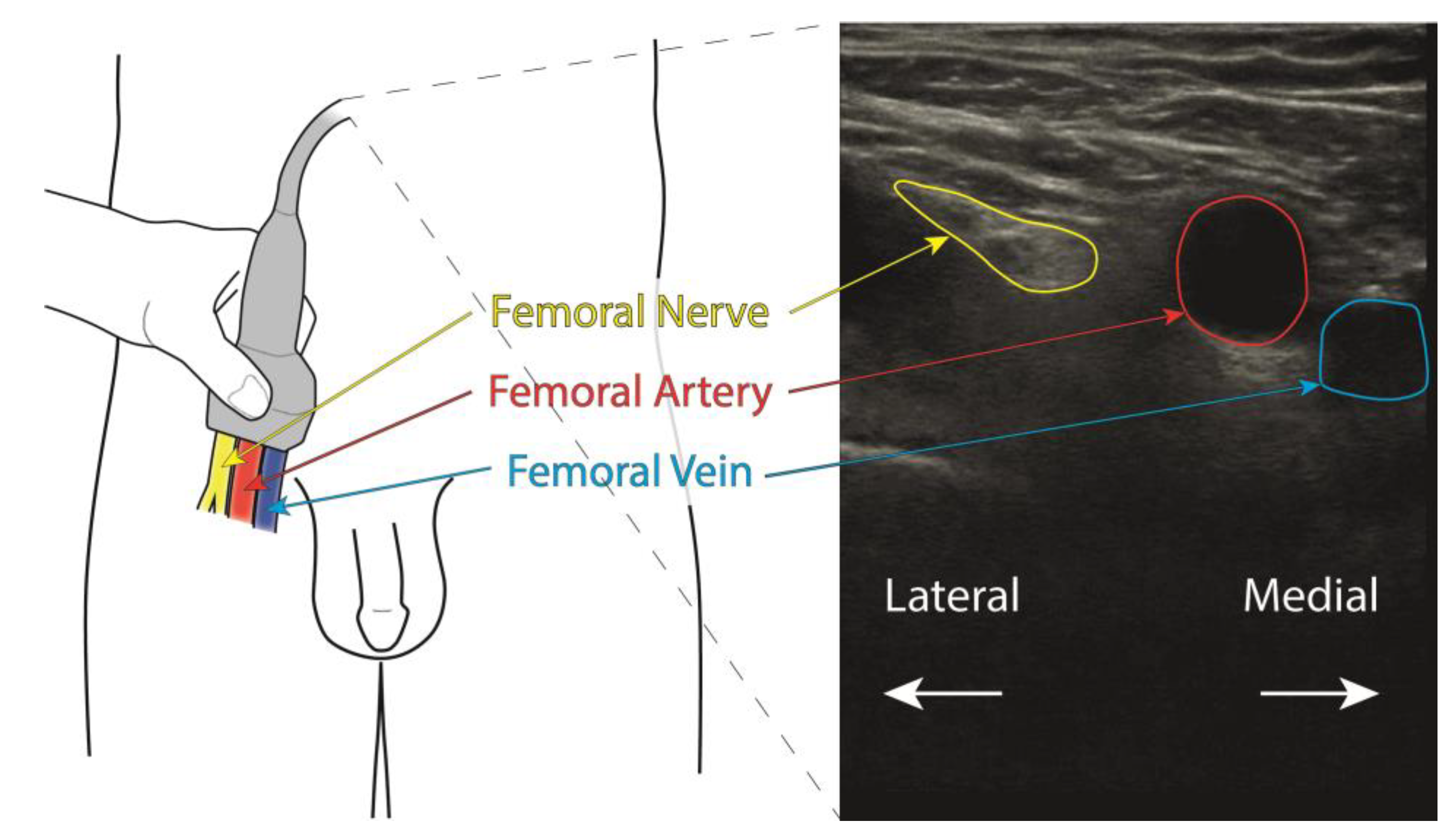 femoral nerve block