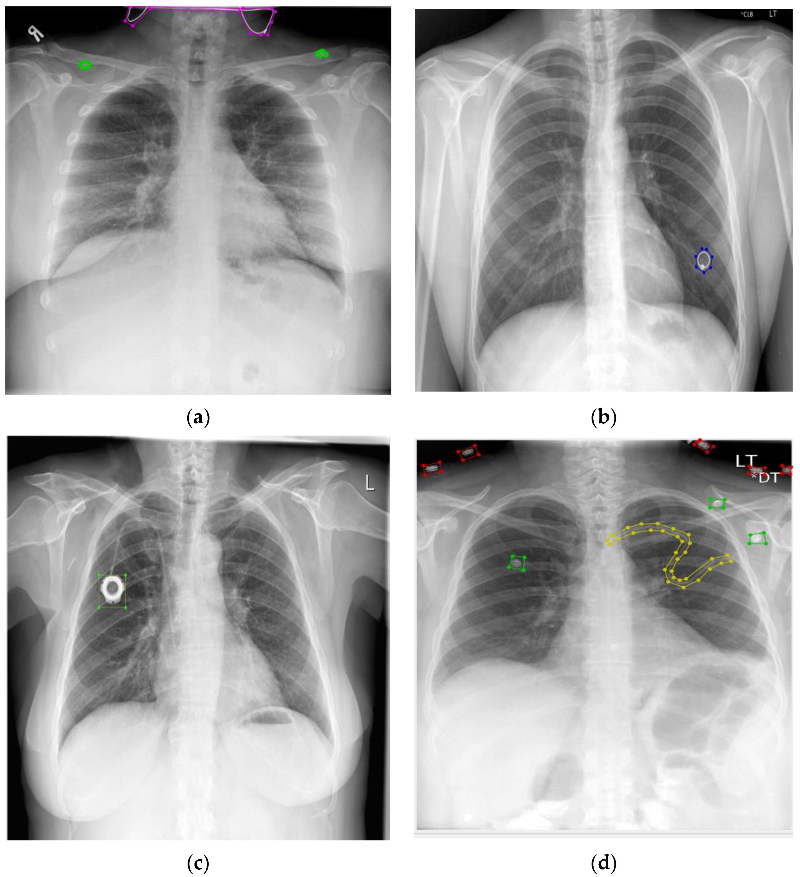 Healthcare | Free Full-Text | Analyzing Overlaid Foreign Objects in Chest X-rays&mdash;Clinical  Significance and Artificial Intelligence Tools